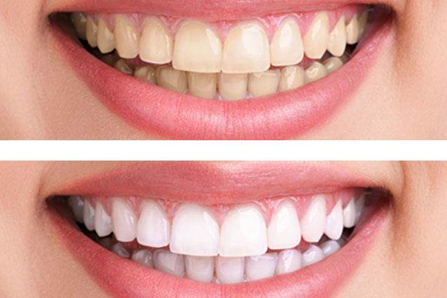 最新动态            洗牙不仅是为了牙齿美白,还能预防牙结石,预防